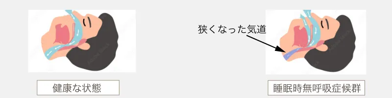 睡眠時無呼吸症候群発生の仕組み